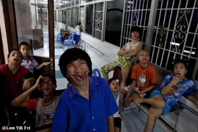 Foto Anak - Anak Korban Agent Orange Di Vietnam