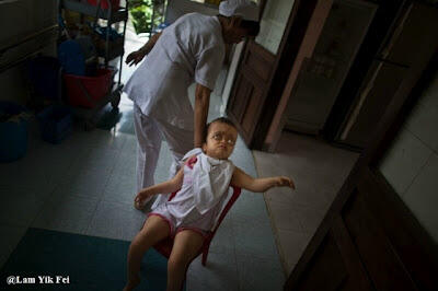 Foto Anak - Anak Korban Agent Orange Di Vietnam