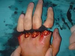 Tangan dipotong akibat sedekah