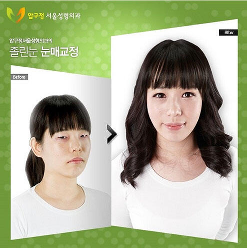 'Sihir Korea', Wajah Sebelum dan Sesudah Operasi Plastik!