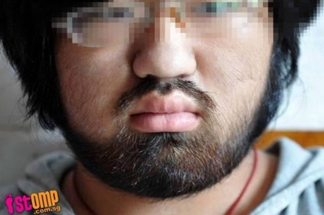 Wajah Si Cantik Jadi Berewokan Gara-gara Efek Samping Obat