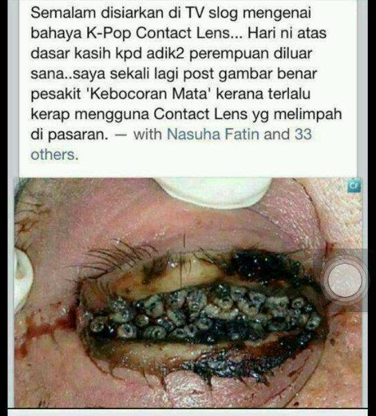 Masih Mau Pakai Lensa Mata Nih Liat Mata Nya Berulat Masuk Gan