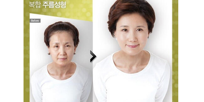 Cantiknya 10 Wanita Korea Setelah Operasi Plastik