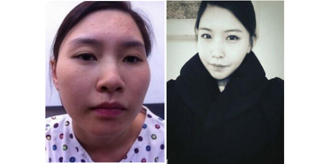 Cantiknya 10 Wanita Korea Setelah Operasi Plastik