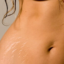 Tips Mencegah Stretch Mark Saat Hamil