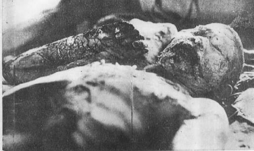 Foto para korban boom atoom hiroshima 