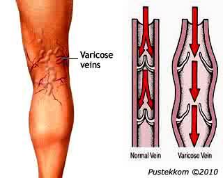 varises oh varises