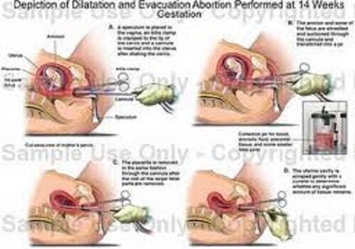 5 Jenis Metode Praktek Aborsi Dan Bahayanya !