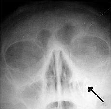 Mengenal Penyakit Sinusitis Secara Sederhana