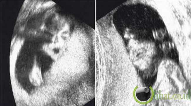 10 Foto Penampakan Ultrasonografi (USG) yang Menakjubkan