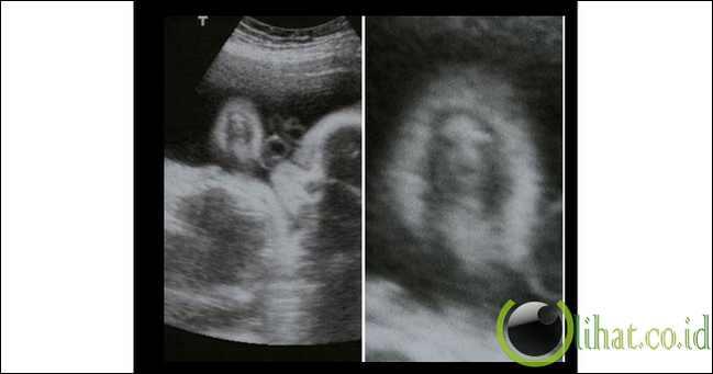 10 Foto Penampakan Ultrasonografi (USG) yang Menakjubkan