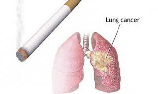 Tanaman Sarang Semut Pencegah Kanker Paru-Paru