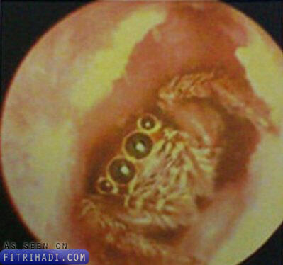 Cara Mengeluarkan Serangga dari Telinga
