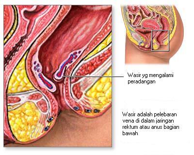 &#91;PENTING&#93; Kaskuser Rentan Kena Penyakit Ambeien!