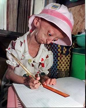 Mengenal Penyakit Progeria atau Penuaan Dini