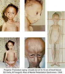 Mengenal Penyakit Progeria atau Penuaan Dini