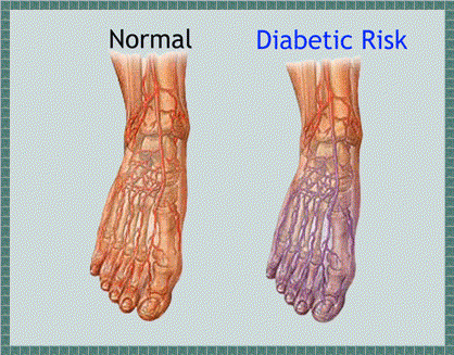 Diabetes neuropati