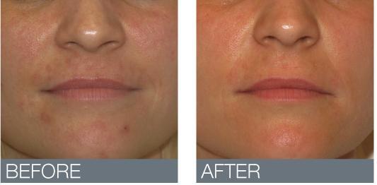 ZA Filler & Skin Booster