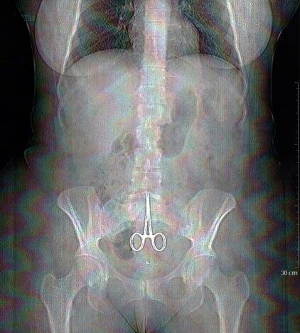  macam macam hasil ronungen alias x-ray