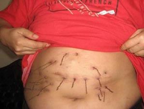 Penyakit mengerikan yang pernah terjadi di Indonesia