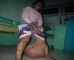 Penyakit mengerikan yang pernah terjadi di Indonesia