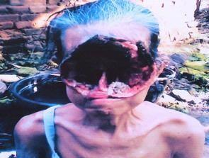 Penyakit mengerikan yang pernah terjadi di Indonesia