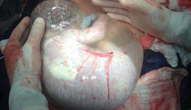 Bayi Ini Lahir Beserta Kantung Ketuban yang Utuh