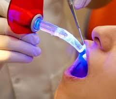 Tambal Gigi sistem laser