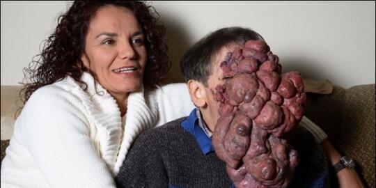 10 Kisah pilu dari penderita penyakit langka !