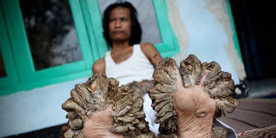 10 Kisah pilu dari penderita penyakit langka !