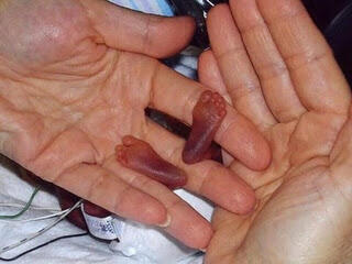 Subhanallah.. janin Berumur 15 Minggu Tapi Masih Bisa Hidup Sampai Saat Ini