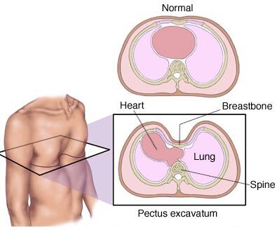 Penyakit Pectus excavatum　(Penyakit Dada Cekung) seperti apa si?