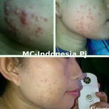 NANO SPRAY DAN MAGIC STICK MCI