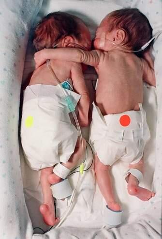 Keajaiban Pelukan, Bayi Selamatkan Saudara Kembarnya