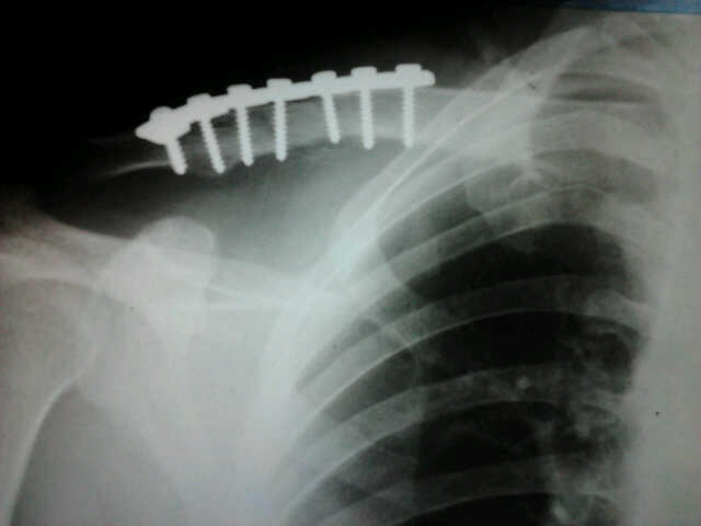 HELP..patah tulang clavicula kanan :(