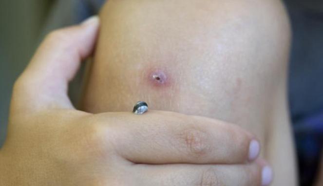 Siput Laut Hitam Menetas di Lutut Bocah 4 Tahun