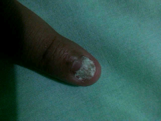 Help Gan! Kuku Ane Kenapa Yah?! :'(