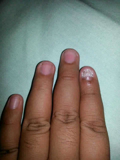 Help Gan! Kuku Ane Kenapa Yah?! :'(