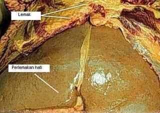 Cegah Timbunan Lemak di Hati (LIVER) dengan Minuman Ini.