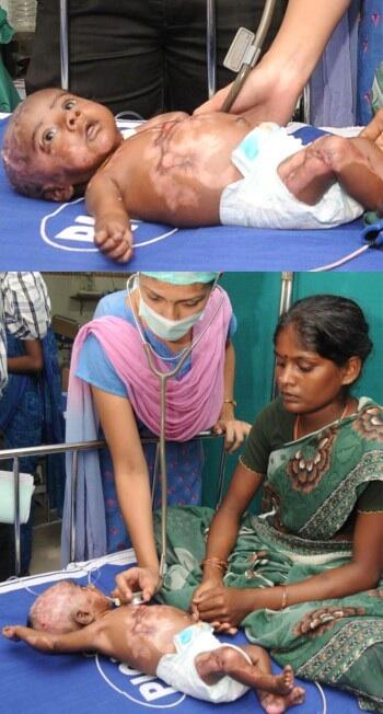 Aneh!! Bayi di India ini mendadak 4 kali terbakar.