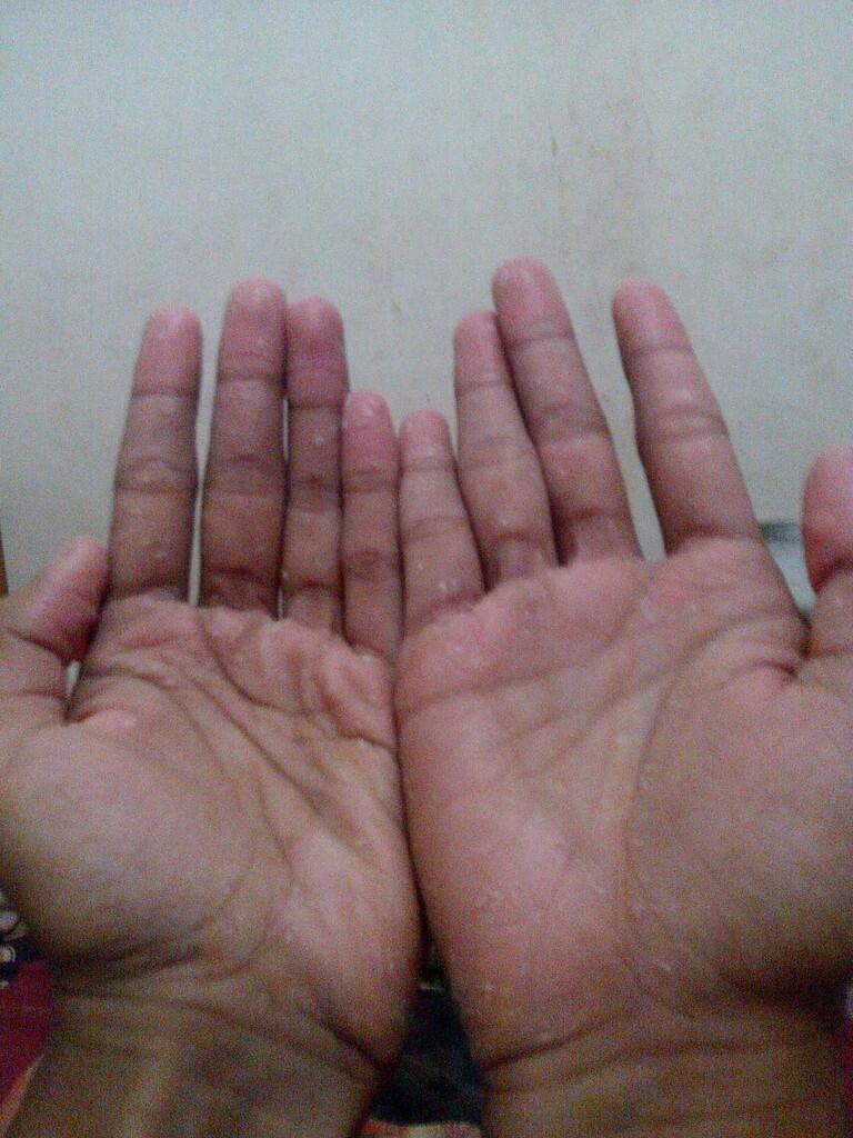 Tangan ane begini gan udah 3 minggu,yg tau obatnya minta saran !!