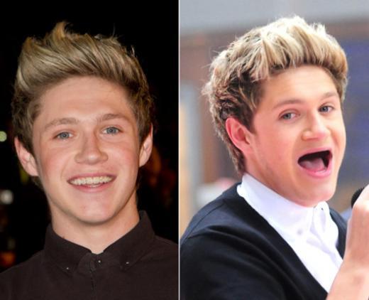 9 Selebriti Hollywood Ini Mendadak Ompong