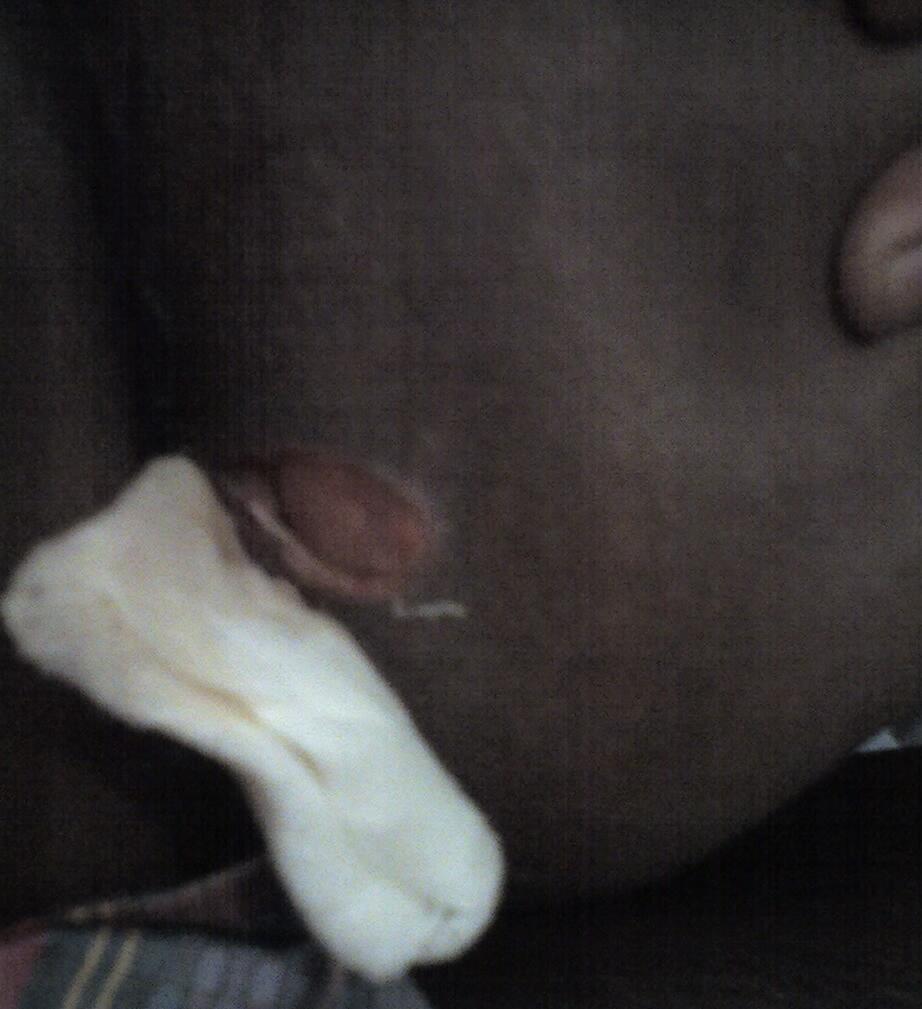 HELPP TENTANG Fistel ( Fistula Ani )