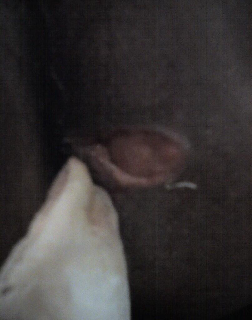 HELPP TENTANG Fistel ( Fistula Ani )