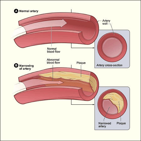 Mitos Kolesterol &quot;The higher cholesterol, the more you live&quot;