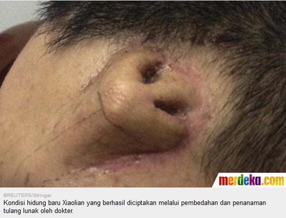 &#91;GILAK&#93; Orang Ini Mempunyai 2 Hidung , Dimana Letaknya ?