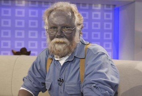 Pria Berkulit Biru Ini Meninggal
