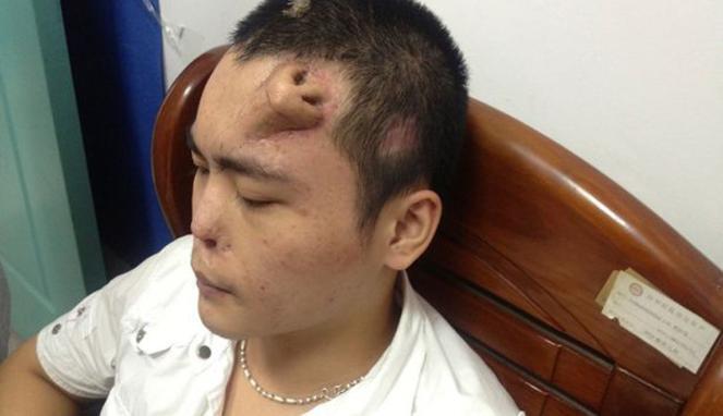 Pria ini memiliki Hidung di Dahi !!!