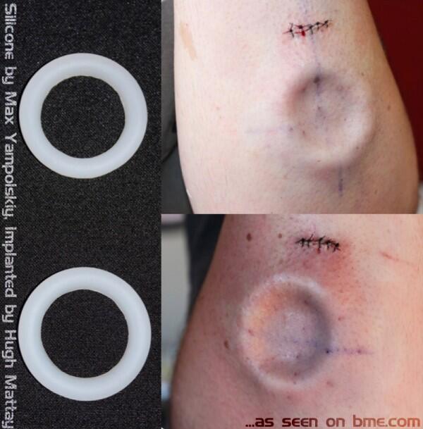 &#91;AGAK BB&#93; Segala Tentang 3D Implants / Body Modification
