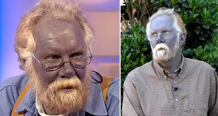 Paul Karason, Pria Dengan Wajah Berwarna Biru